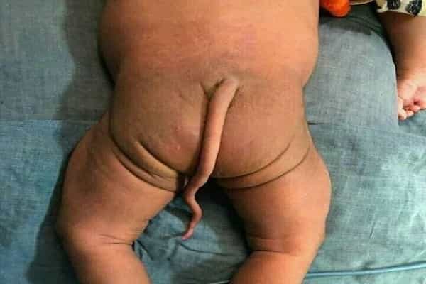 கேரளாவில் வாலுடன் குழந்தை பிறந்து உள்ளதா ? | சாத்தியம் தானா ?