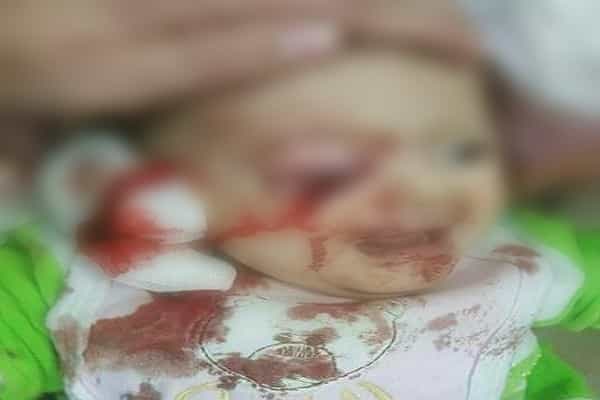 மேற்கு வங்கத்தில் முஸ்லீம்கள் கல்லெறிந்ததில் கண்ணை இழந்த குழந்தையா ?