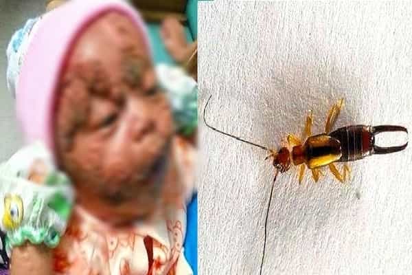 அரிதான பூச்சிக் கடித்ததால் குழந்தையின் முகம் இப்படி மாறியதா ?